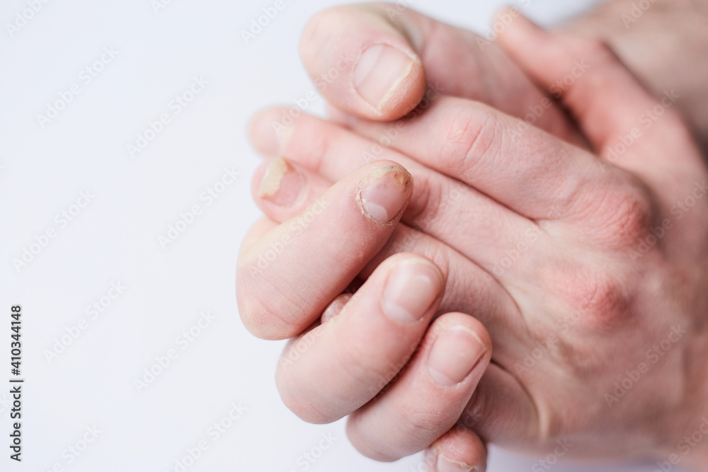 Fungal infection on nails hand, finger with onychomycosis, damage on human hand. Fungal infection on nails hand, finger with onychomycosis, damage on human hand.
