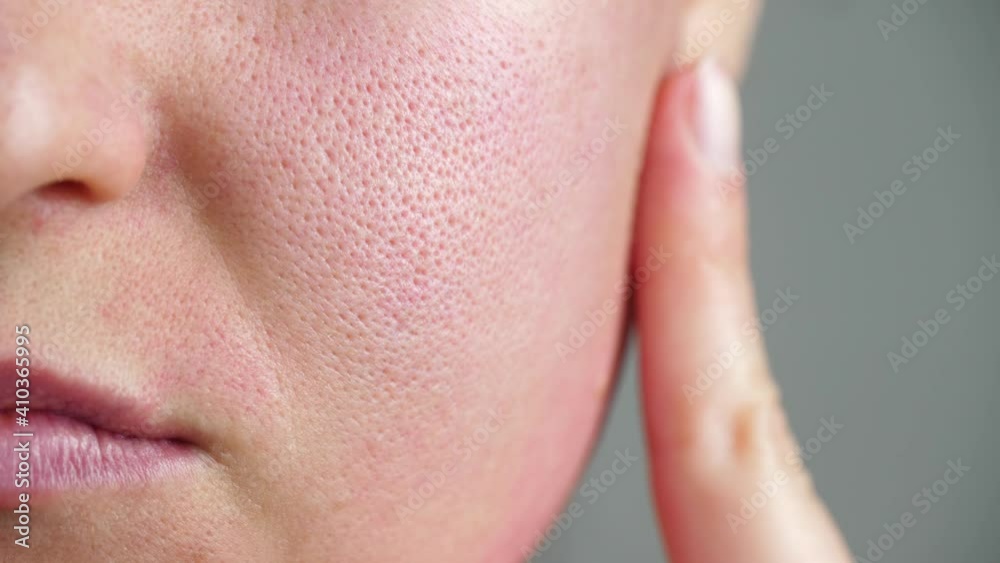 Skin texture with enlarged pores. Part of a woman's face close-up. Irritation, allergies, problem skin. Concept skincare. Beauty face.