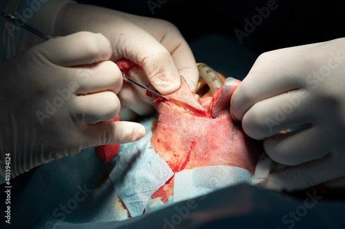 Surgeon cuts an exceed tissue of the lip during the surgery of hemangioma reduce close-up photo