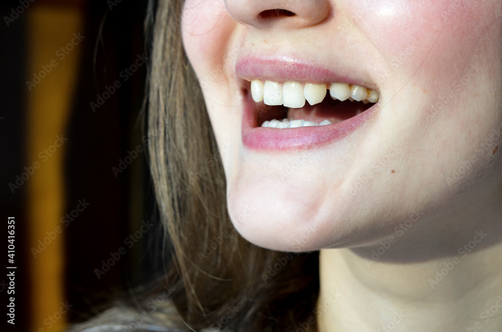 Fototapeta premium Lack of lateral incisors. Teeth before placing