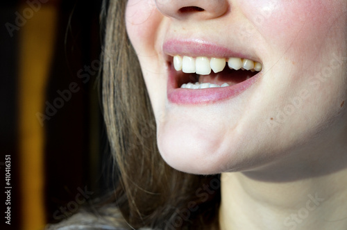 Lack of lateral incisors. Teeth before placing
