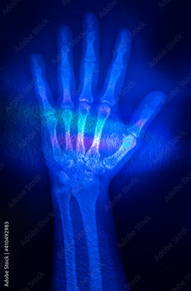 X-ray of female hand due to blow to the finger, negative result of bone fracture, artistic lighting. X-ray of female hand due to blow to the finger, negative result of bone fracture, artistic lighting.