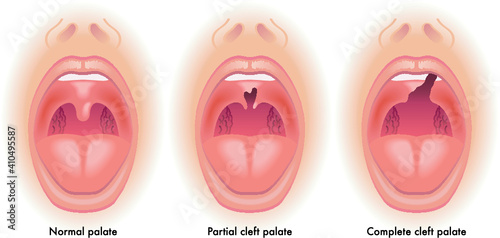 Medical illustration shows the difference between a normal palate, a partial cleft palate, and a complete cleft palate, with annotations.