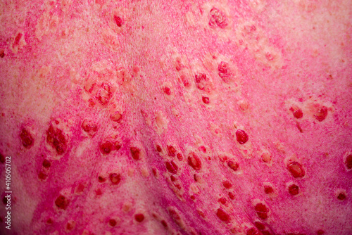 Discoid rash of system lupus erythematosus on the back  photo