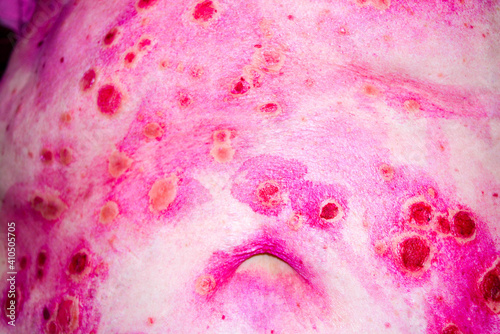 Discoid rash of system lupus erythematosus on the tummy photo