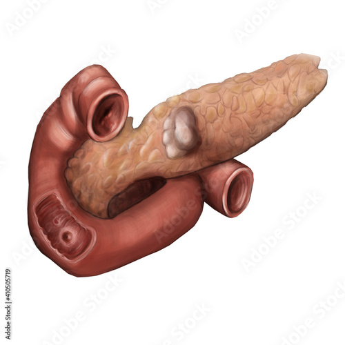 Zollinger Ellison syndrome. Illustration of the pancreatic cancer and duodenal ulcer photo