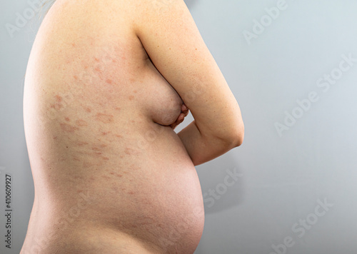 Red rash on the skin of a pregnant woman. Avitaminosis. 