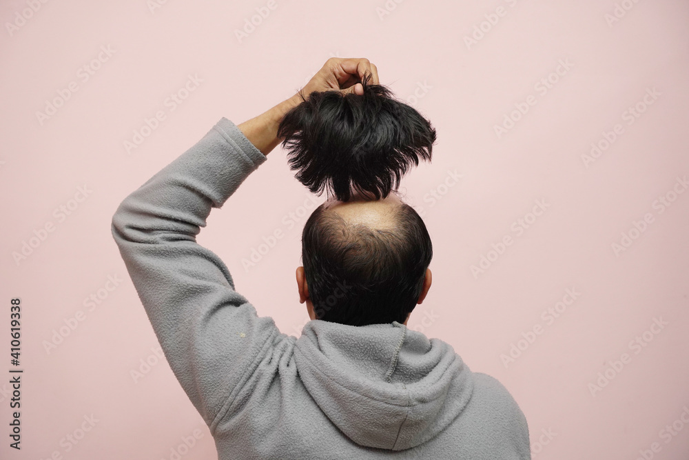 Closeup of a half-bald male removing his wig while wearing a hoodie with a pink background - obrazy, fototapety, plakaty 