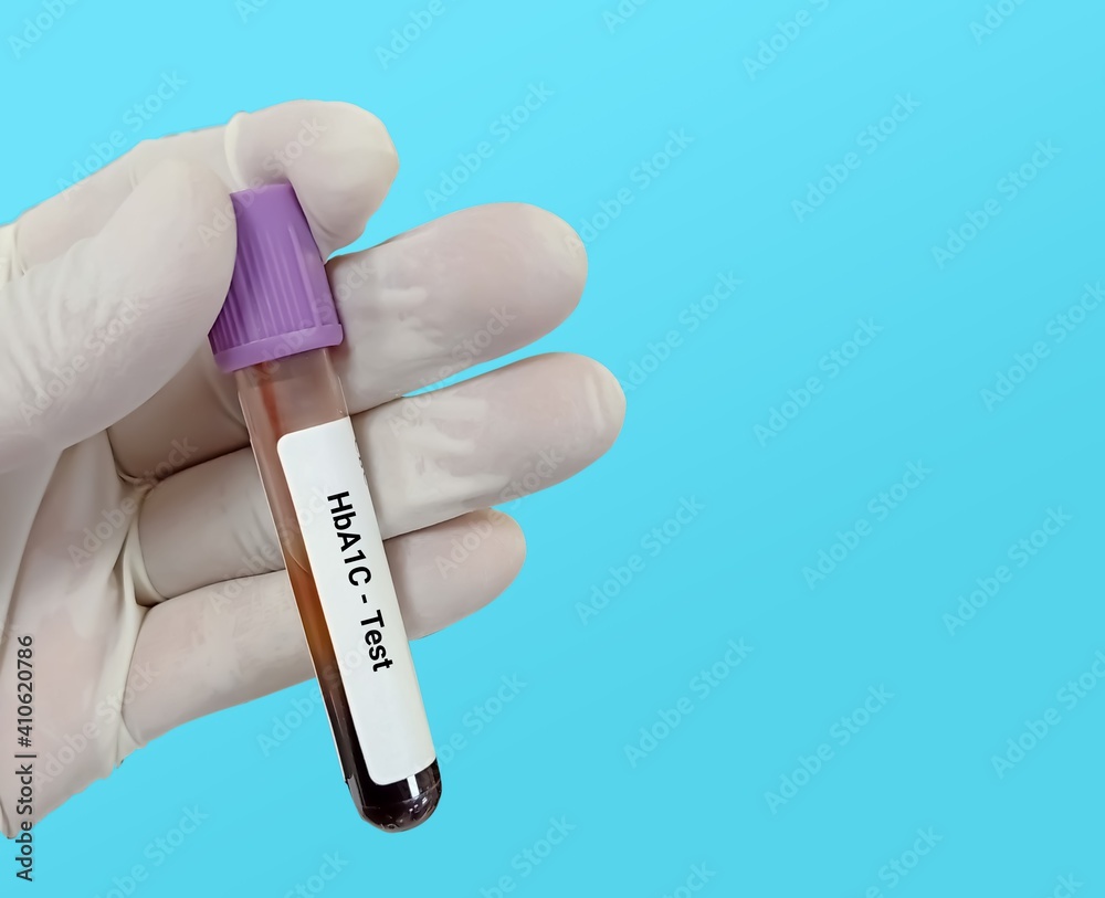 Biochemist or Lab Technologist holds Blood sample for HbA1c (Hemoglobin