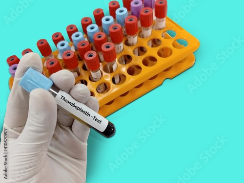 Biochemist or Lab Technologist holds Blood samples for thromboplastin or factor 3 test, diagnosis of coagulation disorder test in the laboratory background. photo