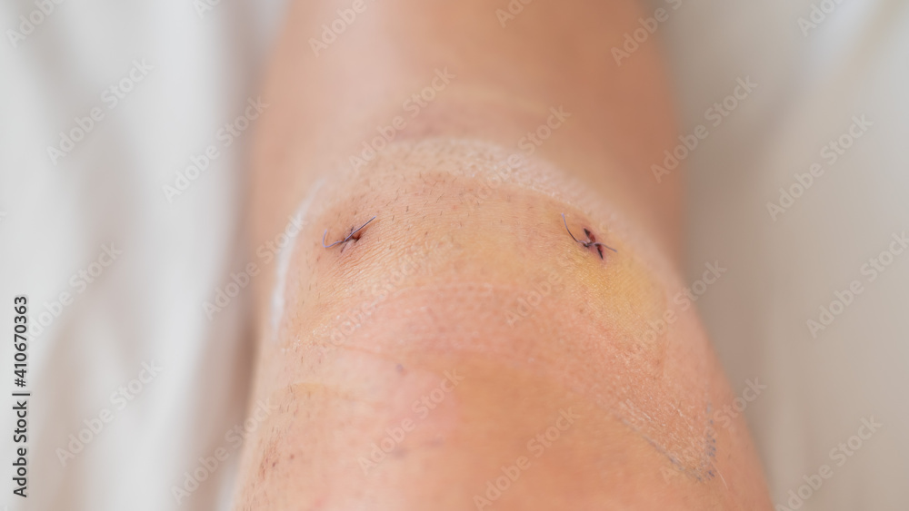 Close-up of a surgical suture on the knee after laparoscopic meniscus surgery. Close-up of a surgical suture on the knee after laparoscopic meniscus surgery.