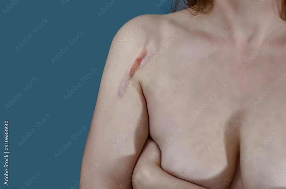 Fototapeta premium Woman covers chest with arm, scar on top of shoulder