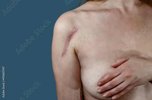 Woman covers chest with arm  scar on top of shoulder