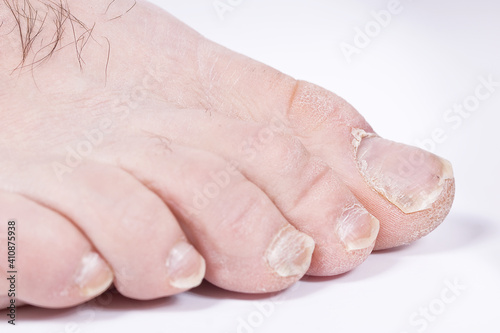 Wallpaper Mural damaged toenails. Onychomycosis, nail psoriasis Torontodigital.ca