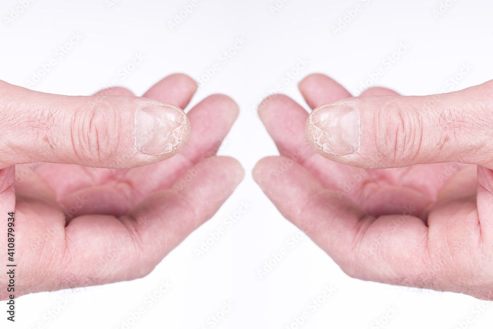 damaged hands of the person damaged hands of the person