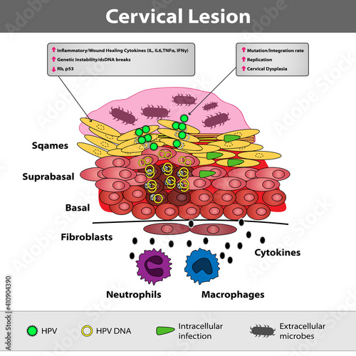 A precancerous cervical lesion. Abnormal cervical appearance. Squamous and glandular cells. Medical vector illustration