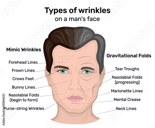 An illustration of two types of wrinkles such as expression and gravity on a man's face. On one half of the man's face wrinkles only began to form, and the other half shows the wrinkles of old age 