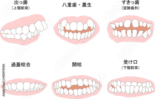 歯列矯正治療の対象になる代表的な症例セット　ベタ塗り線あり