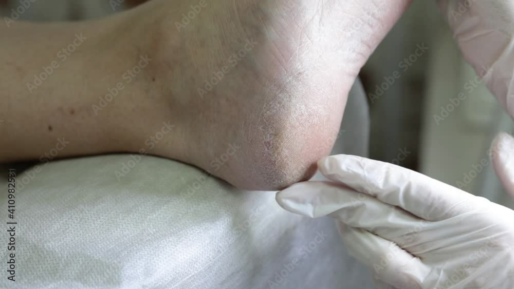 Examination at a doctor-podolog appointment. Problematic diabetic foot in a woman. Dry skin on the sole and heel. Medical hardware pedicure in a beauty salon. Examination at a doctor-podolog appointment. Problematic diabetic foot in a woman. Dry skin on the sole and heel. Medical hardware pedicure in a beauty salon.