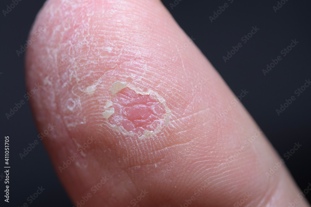 close up of a finger with eczema close up of a finger with eczema