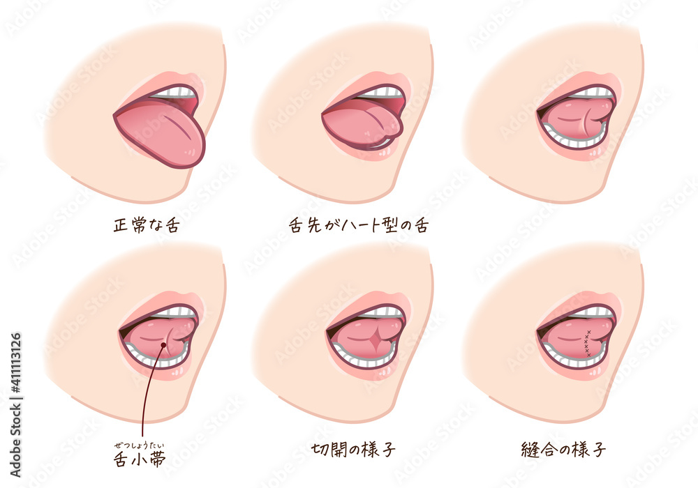 舌小帯短縮症のイラスト Stock Vector Adobe Stock