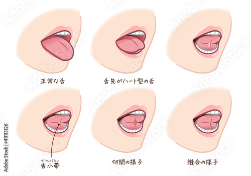 舌小帯短縮症のイラスト