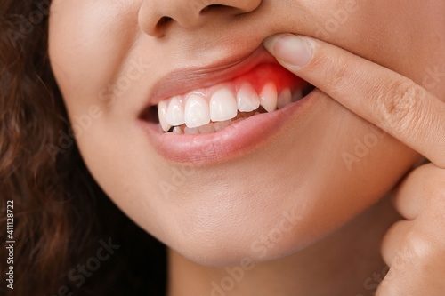 Woman with gum inflammation, closeup photo