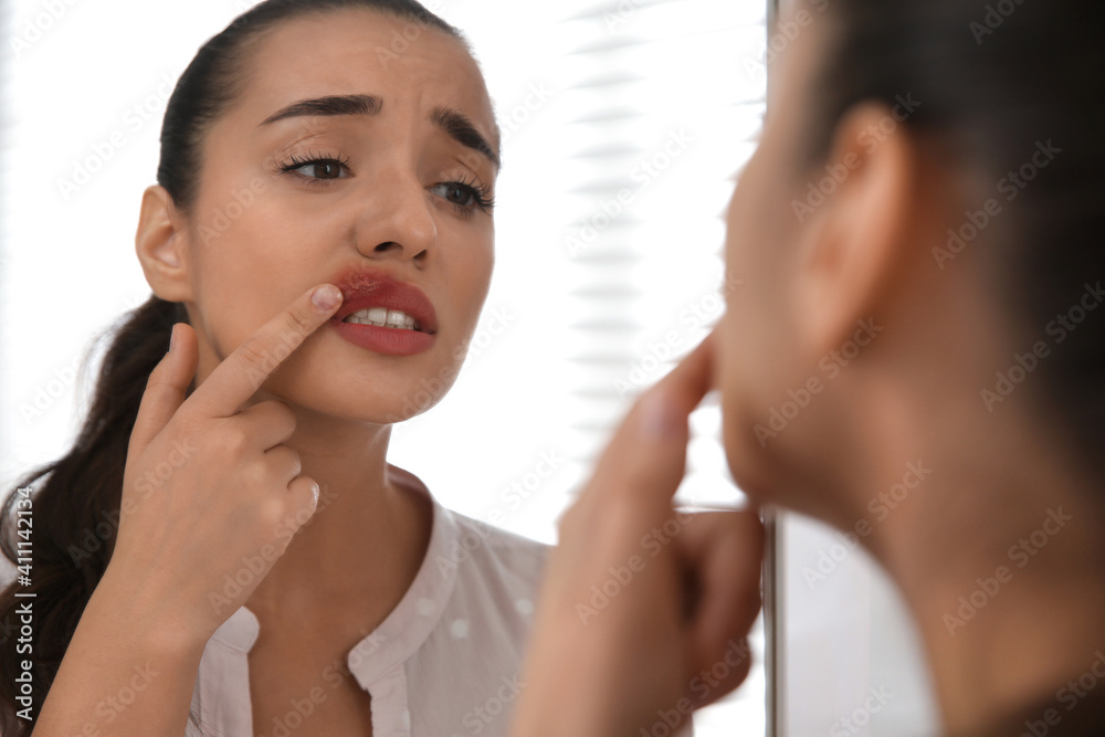 Young woman with herpes touching lips in front of mirror at home Young woman with herpes touching lips in front of mirror at home