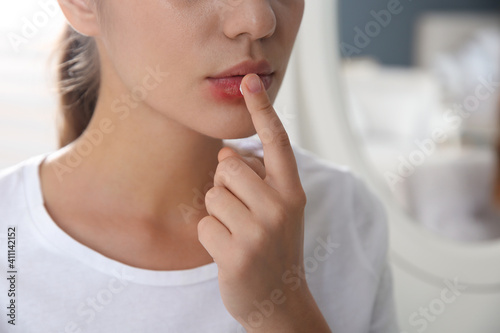 Woman with herpes applying cream on lips against blurred background  closeup