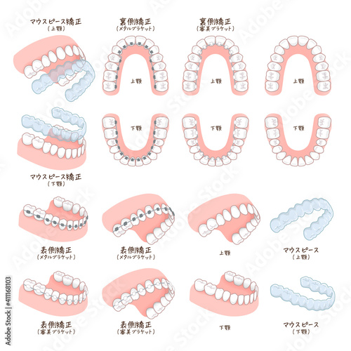 歯列矯正のイラスト