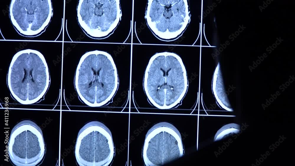 Medical scientist scrolls CT, MRI brain scan images on a big screen