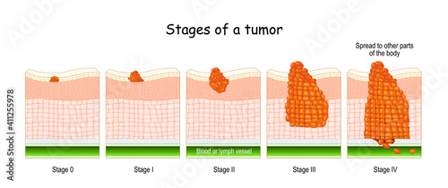 stages of cancer. Classification of Malignant Tumours