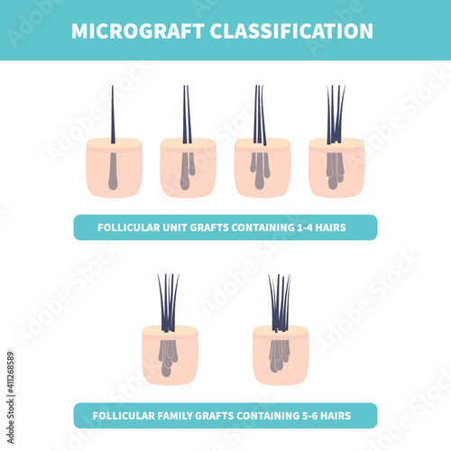 Hair micrograft classification set for hair transplantation surgery. Skin cross-section with number of hairs in the follicular unit or family. Hair science and anatomy. Cartoon vector illustration.