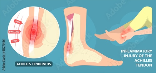 Achilles tendon rupture injury Feet calf test range of motion slight ache problem limb Thompson Simmonds photo