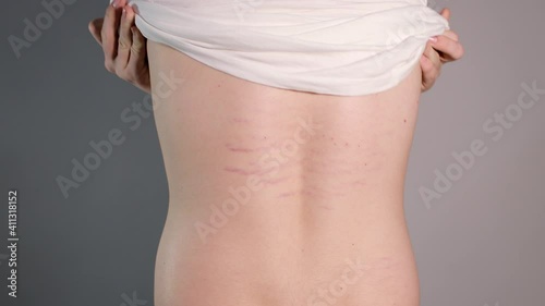 Close up view of young pearson's back with striae distensae (striae rubrae) background. The concept of impaired skin elasticity during puberty