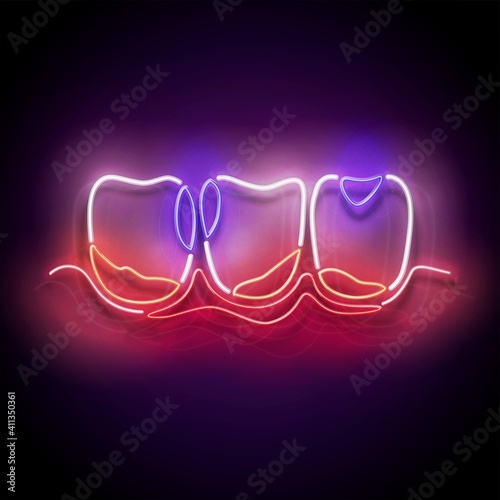 Glow Dentition with Caries and Inflamed Gum. Dentist Clinic Concept Template. Neon Light Poster, Flyer, Banner, Signboard. Glossy Background. Vector 3d Illustration