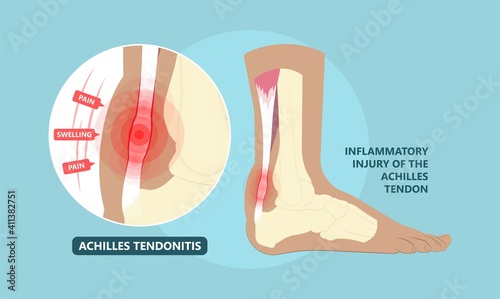 Achilles tendon rupture injury Feet calf test range of motion slight ache problem limb Thompson Simmonds