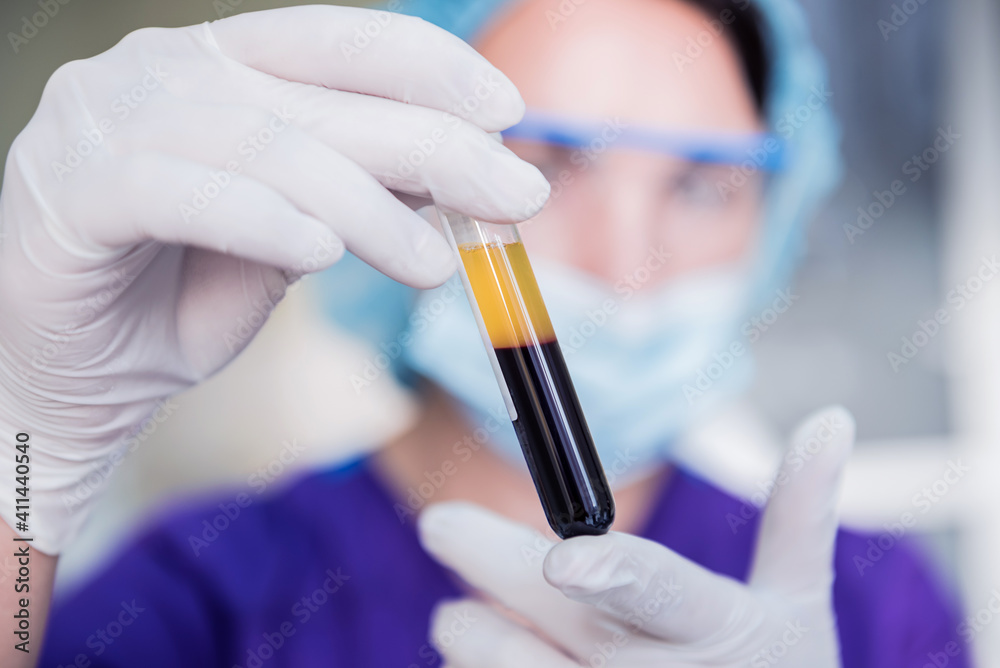 Platelet-Rich plasma preparation. Tube with plasma in hands