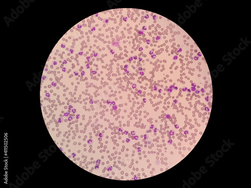 Leukemoid reaction describes an increased white blood cell count, or leukocytosis, which is a physiological response to stress or infection. Canine peripheral blood smear under light microscope. photo