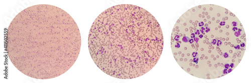 Leukemoid reaction describes an increased white blood cell count, or leukocytosis, which is a physiological response to stress or infection. Canine peripheral blood smear under light microscope.