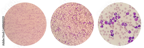 Leukemoid reaction describes an increased white blood cell count, or leukocytosis, which is a physiological response to stress or infection. Canine peripheral blood smear under light microscope. photo