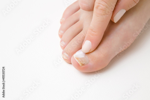 Young adult woman finger using and applying moisturizing cream on toe nail. Dry damaged female toe nails. White background. Closeup.