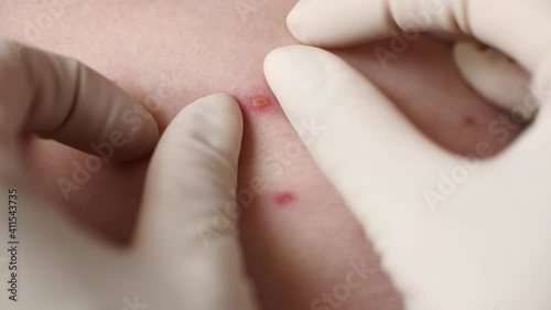 Close-up doctor examines skin full of blisters, scars and rashes caused by varicella chickenpox. A man who having varicella blisters or chickenpox on a back, chicken pox disease.