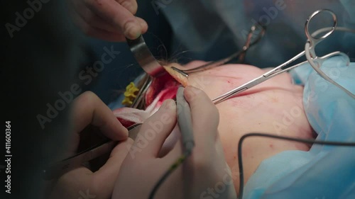 Plastic surgeon performs facelift surgery with a scalpel, tweezers and clamps, close up. High quality FullHD footage