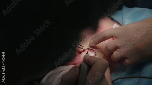 Plastic surgeon performs facelift surgery with a scalpel, tweezers and clamps, close up. High quality FullHD footage
