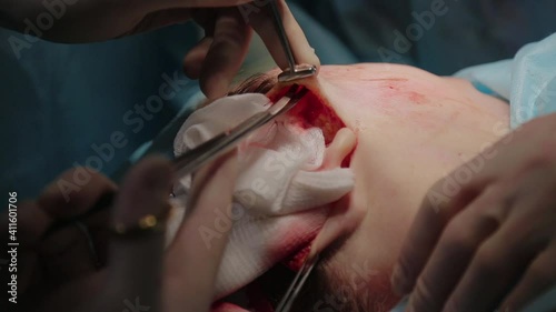 Plastic surgeon performs facelift surgery with a scalpel, tweezers and clamps, close up. High quality FullHD footage