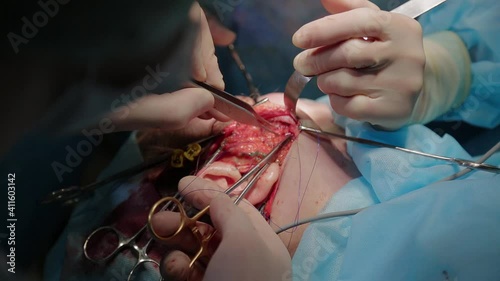 Plastic surgeon performs facelift surgery with a scalpel, tweezers and clamps, close up. High quality FullHD footage