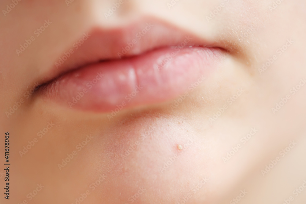 Teenage acne on the chin. Close up face with pimple. Teen problem. High quality photo.