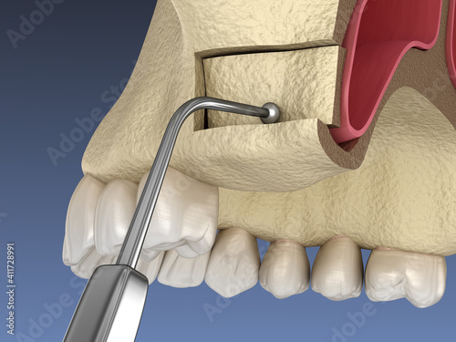 Sinus Lift Surgery - Creating side access to the Sinus. 3D illustration photo