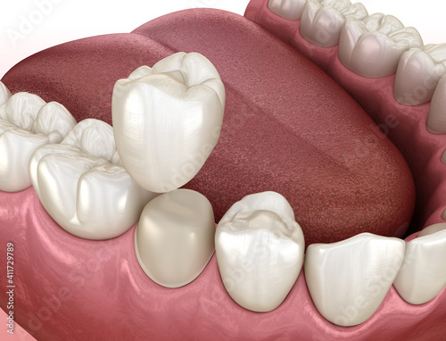 Preparated premolar tooth and dental crown placement. Medically accurate 3D illustration
